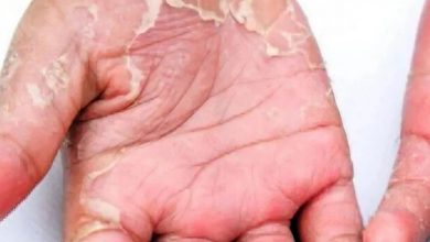 What to do if the skin of the hands and feet rises in winter
